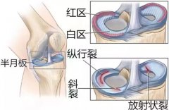 膝關節半月板損傷的臨床表現